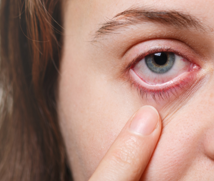 person showing their dry eyes